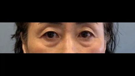 Sub-brow Lift, Lower Blepharoplasty (Aging Eye Rejuvenation), Midface Lift — RE&RE PLASTIC SURGERY 1