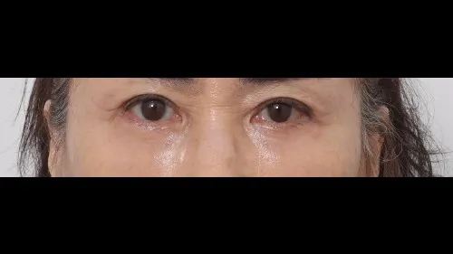 Sub-brow Lift, Lower Blepharoplasty (Aging Eye Rejuvenation), Midface Lift — RE&RE PLASTIC SURGERY 4