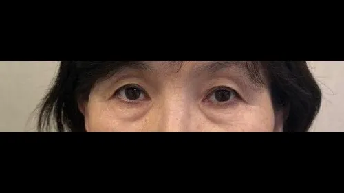 Sub-brow Lift, Lower Blepharoplasty (Aging Eye Rejuvenation) — RE&RE PLASTIC SURGERY 1