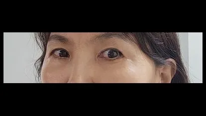 Sub-brow Lift, Lower Blepharoplasty (Aging Eye Rejuvenation) — RE&RE PLASTIC SURGERY 2