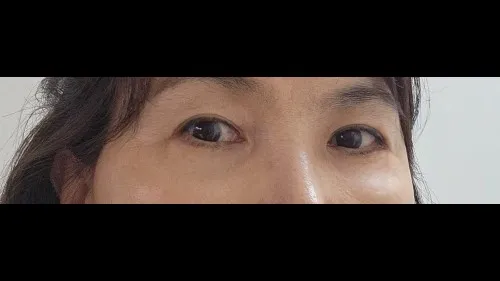 Sub-brow Lift, Lower Blepharoplasty (Aging Eye Rejuvenation) — RE&RE PLASTIC SURGERY 3