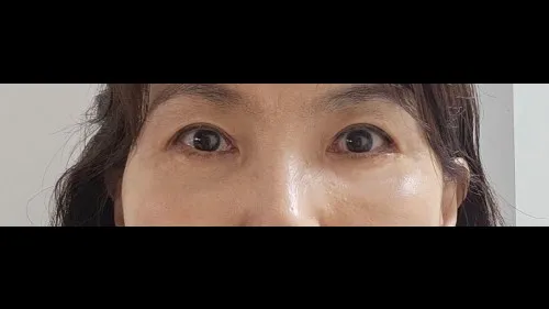 Sub-brow Lift, Lower Blepharoplasty (Aging Eye Rejuvenation) — RE&RE PLASTIC SURGERY 5