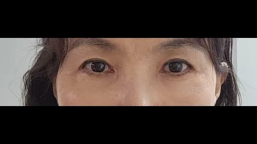 Sub-brow Lift, Lower Blepharoplasty (Aging Eye Rejuvenation) — RE&RE PLASTIC SURGERY 6