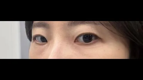 Natural Adhesion Double Eyelid Surgery, Ptosis Correction — RE&RE PLASTIC SURGERY 2
