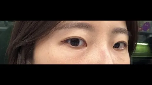 Natural Adhesion Double Eyelid Surgery, Ptosis Correction — RE&RE PLASTIC SURGERY 3
