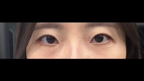 Natural Adhesion Double Eyelid Surgery, Ptosis Correction — RE&RE PLASTIC SURGERY 5