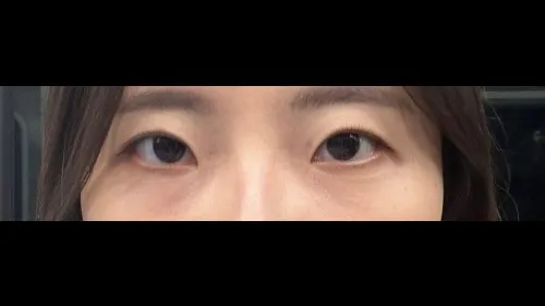 Natural Adhesion Double Eyelid Surgery, Ptosis Correction — RE&RE PLASTIC SURGERY 6