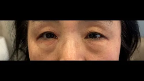 Sub-brow Lift, Lower Blepharoplasty (Aging Eye Rejuvenation) — RE&RE PLASTIC SURGERY 1