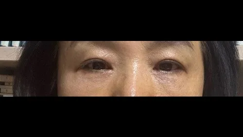 Sub-brow Lift, Lower Blepharoplasty (Aging Eye Rejuvenation) — RE&RE PLASTIC SURGERY 2