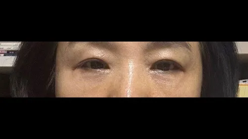 Sub-brow Lift, Lower Blepharoplasty (Aging Eye Rejuvenation) — RE&RE PLASTIC SURGERY 4