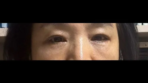 Sub-brow Lift, Lower Blepharoplasty (Aging Eye Rejuvenation) — RE&RE PLASTIC SURGERY 5