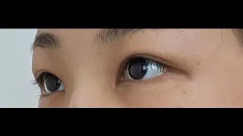 Incisional Double Eyelid Surgery — RE&RE PLASTIC SURGERY 2