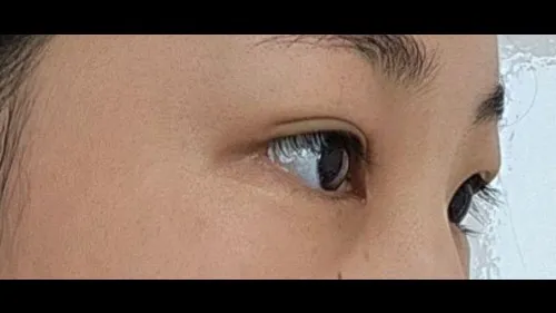 Incisional Double Eyelid Surgery — RE&RE PLASTIC SURGERY 3