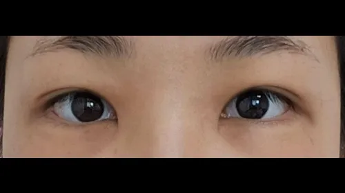 Incisional Double Eyelid Surgery — RE&RE PLASTIC SURGERY 4