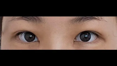 Incisional Double Eyelid Surgery — RE&RE PLASTIC SURGERY 5