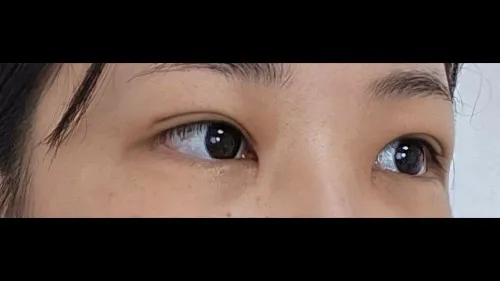 Incisional Double Eyelid Surgery — RE&RE PLASTIC SURGERY 6