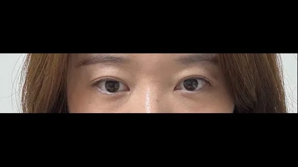 Natural Adhesion Double Eyelid Surgery, Ptosis Correction — RE&RE PLASTIC SURGERY 3