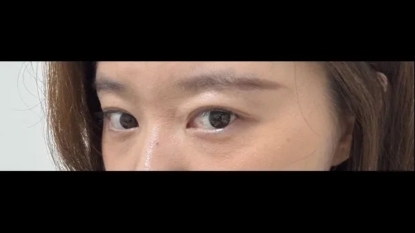 Natural Adhesion Double Eyelid Surgery, Ptosis Correction — RE&RE PLASTIC SURGERY 4
