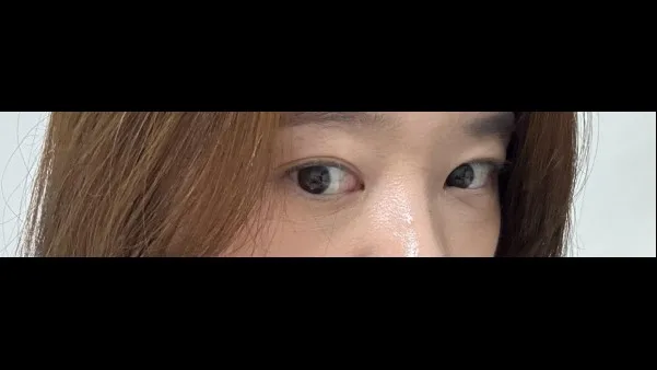 Natural Adhesion Double Eyelid Surgery, Ptosis Correction — RE&RE PLASTIC SURGERY 5