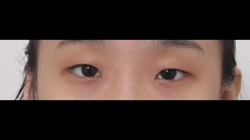 Partial Incision Double Eyelid Surgery, Ptosis Correction — RE&RE PLASTIC SURGERY 1