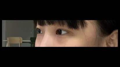 Partial Incision Double Eyelid Surgery, Ptosis Correction 2