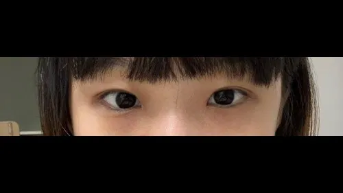 Partial Incision Double Eyelid Surgery, Ptosis Correction — RE&RE PLASTIC SURGERY 3