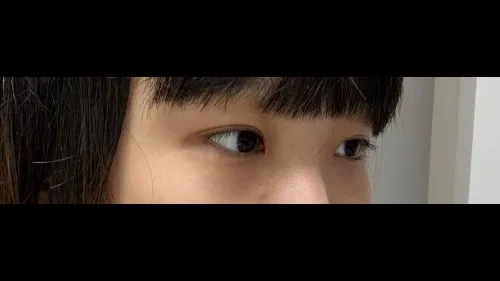 Partial Incision Double Eyelid Surgery, Ptosis Correction — RE&RE PLASTIC SURGERY 4