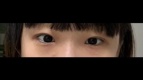 Partial Incision Double Eyelid Surgery, Ptosis Correction — RE&RE PLASTIC SURGERY 5