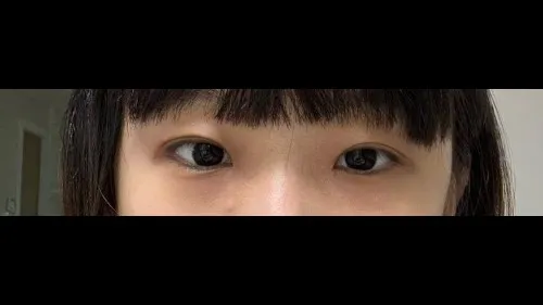 Partial Incision Double Eyelid Surgery, Ptosis Correction — RE&RE PLASTIC SURGERY 6