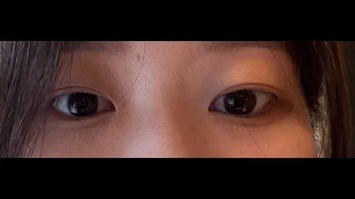 Natural Adhesion Double Eyelid Surgery — RE&RE PLASTIC SURGERY 2