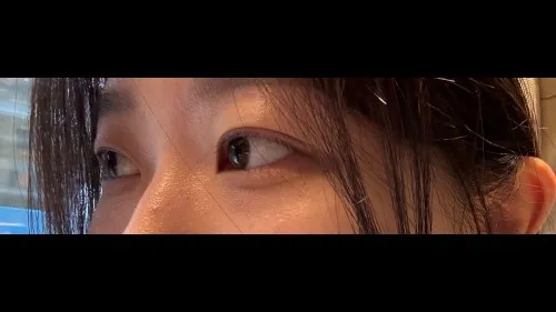 Natural Adhesion Double Eyelid Surgery — RE&RE PLASTIC SURGERY 3