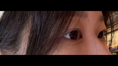 Natural Adhesion Double Eyelid Surgery — RE&RE PLASTIC SURGERY 4