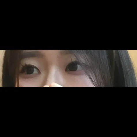 Natural Adhesion Double Eyelid Surgery — RE&RE PLASTIC SURGERY 5