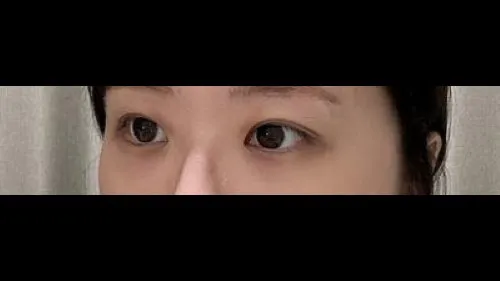 Incisional Double Eyelid Surgery — RE&RE PLASTIC SURGERY 2