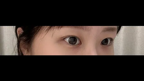 Incisional Double Eyelid Surgery — RE&RE PLASTIC SURGERY 3