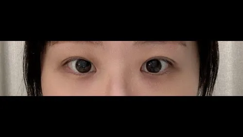 Incisional Double Eyelid Surgery — RE&RE PLASTIC SURGERY 4