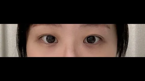 Incisional Double Eyelid Surgery — RE&RE PLASTIC SURGERY 5