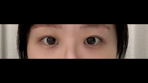 Incisional Double Eyelid Surgery — RE&RE PLASTIC SURGERY 6
