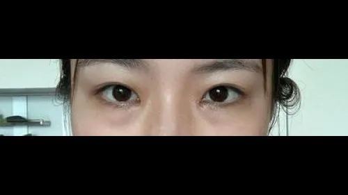 Partial Incision Double Eyelid Surgery, Ptosis Correction — RE&RE PLASTIC SURGERY 2