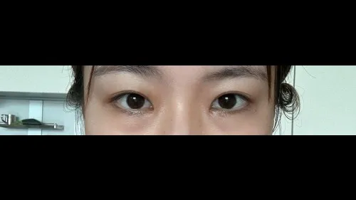 Partial Incision Double Eyelid Surgery, Ptosis Correction — RE&RE PLASTIC SURGERY 3