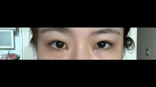 Partial Incision Double Eyelid Surgery, Ptosis Correction — RE&RE PLASTIC SURGERY 4