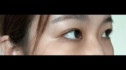 Partial Incision Double Eyelid Surgery, Ptosis Correction — RE&RE PLASTIC SURGERY 5