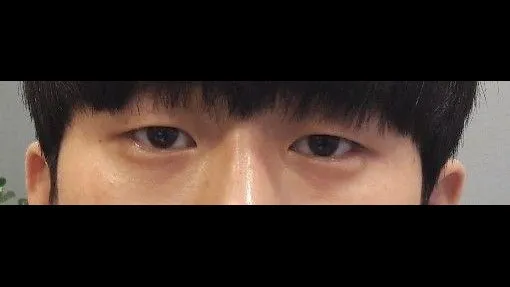 Natural Adhesion Double Eyelid Surgery — RE&RE PLASTIC SURGERY 1