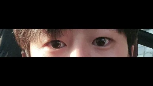 Natural Adhesion Double Eyelid Surgery — RE&RE PLASTIC SURGERY 2