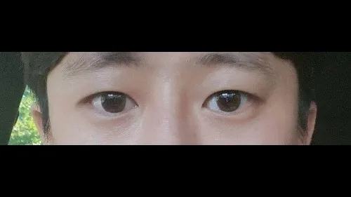 Natural Adhesion Double Eyelid Surgery — RE&RE PLASTIC SURGERY 3