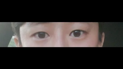 Natural Adhesion Double Eyelid Surgery — RE&RE PLASTIC SURGERY 4