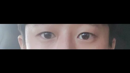 Natural Adhesion Double Eyelid Surgery — RE&RE PLASTIC SURGERY 5