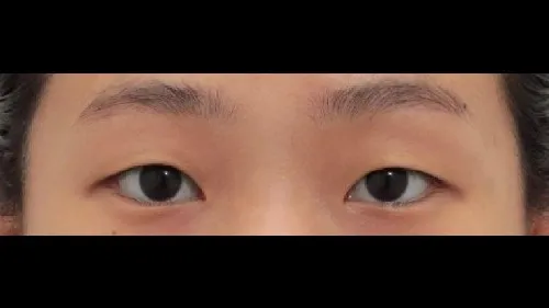 Incisional Double Eyelid Surgery, Ptosis Correction — RE&RE PLASTIC SURGERY 1