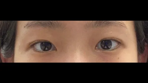 Incisional Double Eyelid Surgery, Ptosis Correction — RE&RE PLASTIC SURGERY 2