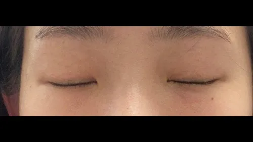 Incisional Double Eyelid Surgery, Ptosis Correction — RE&RE PLASTIC SURGERY 3